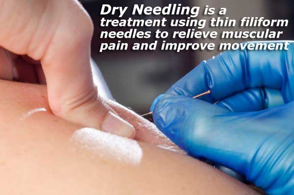 An image of a person applying a dry needle to discuss dry needling benefits.